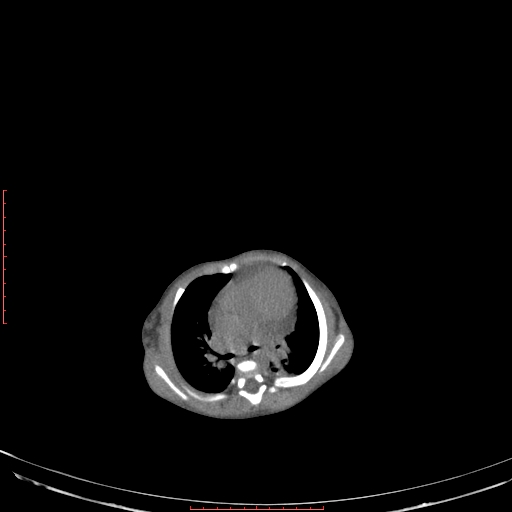 File:Autosomal recessive polycystic kidney disease associated with Caroli disease (Radiopaedia 61932-69984 Axial non-contrast 50).jpg