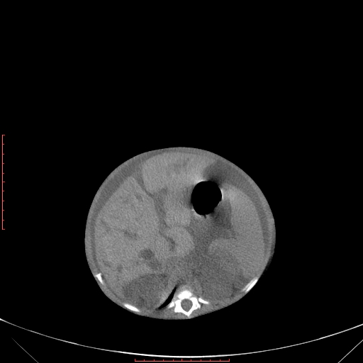 Autosomal recessive polycystic kidney disease associated with Caroli disease (Radiopaedia 61932-69984 B 154).jpg
