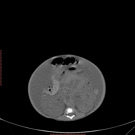 Autosomal recessive polycystic kidney disease associated with Caroli disease (Radiopaedia 61932-69984 B 222).jpg