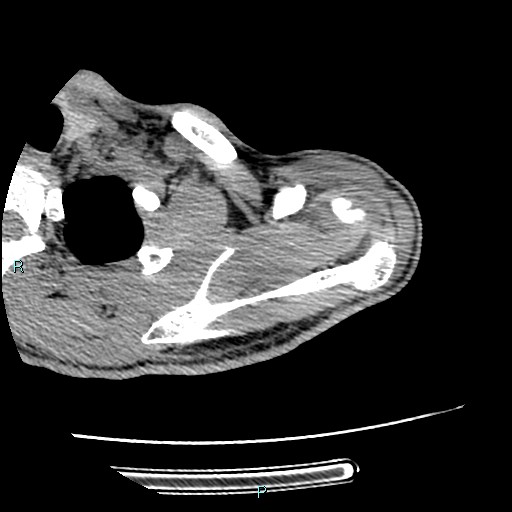 File:Avascular necrosis after fracture dislocations of the proximal humerus (Radiopaedia 88078-104655 D 33).jpg