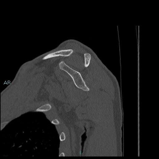 Avascular necrosis after fracture dislocations of the proximal humerus (Radiopaedia 88078-104655 Sagittal bone window 37).jpg