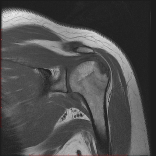 File:Avulsion fracture - greater tuberosity of humerus (Radiopaedia 25457-25703 Coronal T1 8).jpg
