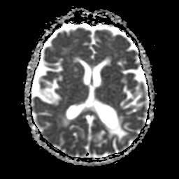 File:Balo concentric sclerosis (Radiopaedia 53875-59982 Axial ADC 14).jpg