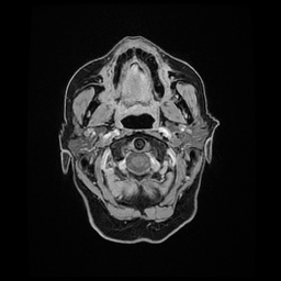 Balo concentric sclerosis (Radiopaedia 53875-59982 Axial LAVA C+ 14).jpg