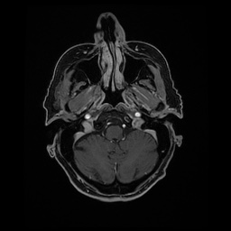 Balo concentric sclerosis (Radiopaedia 53875-59982 Axial LAVA C+ 50).jpg