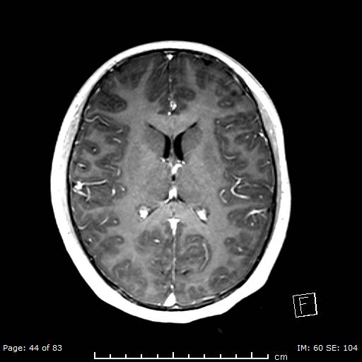Balo concentric sclerosis (Radiopaedia 61637-69636 Axial T1 C+ 44).jpg
