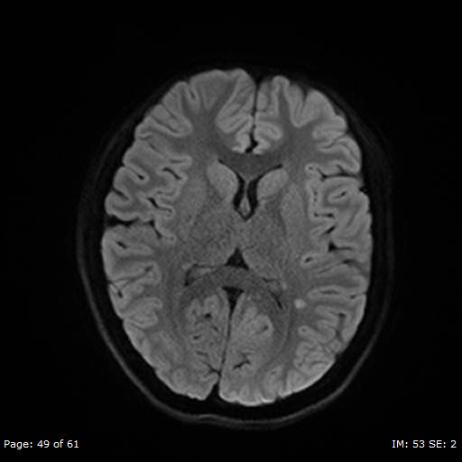 Balo concentric sclerosis (Radiopaedia 61637-69636 I 315).jpg