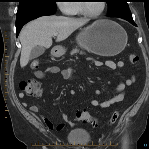 File:Bariatric balloon causing gastric outlet obstruction (Radiopaedia 54449-60672 B 22).jpg