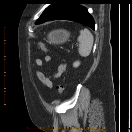 File:Bariatric balloon causing gastric outlet obstruction (Radiopaedia 54449-60672 C 14).jpg