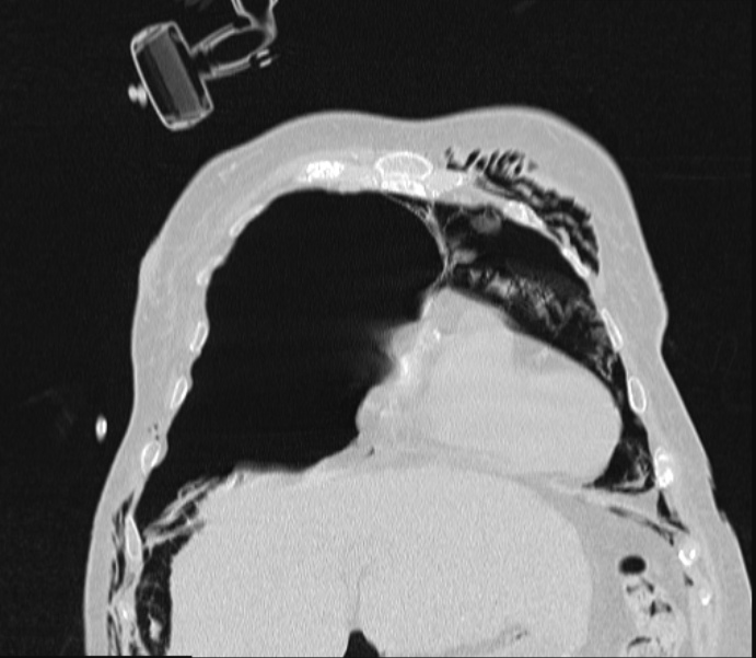 Barotrauma due to mechanical ventilation (Radiopaedia 28079-28336 Coronal lung window 25).jpg