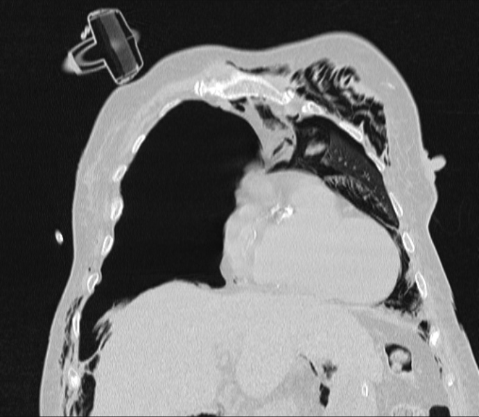 Barotrauma due to mechanical ventilation (Radiopaedia 28079-28336 Coronal lung window 31).jpg