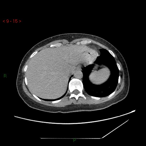File:Bartholin gland cyst (Radiopaedia 54904-61181 Axial C+ delayed 4).jpg