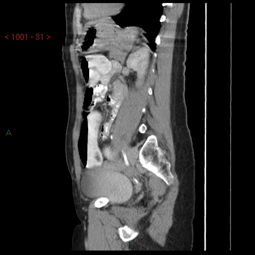File:Bartholin gland cyst (Radiopaedia 54904-61181 Sagittal C+ delayed 31).jpg
