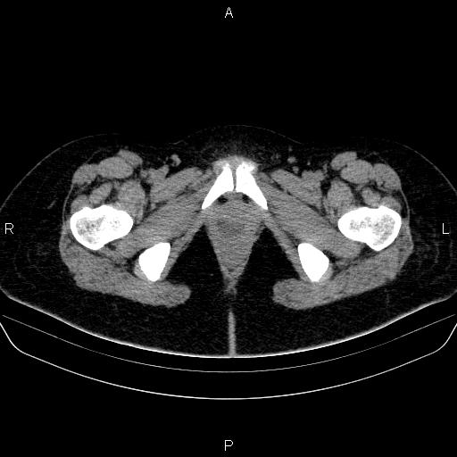 Bartholin gland cyst (Radiopaedia 62635-70930 Axial non-contrast 85).jpg