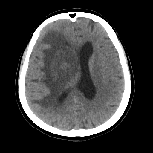 File:Basal ganglia metastasis (Radiopaedia 78928-91830 Axial non-contrast 38).png