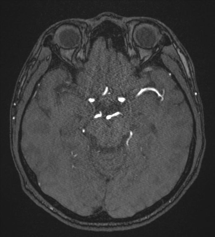 Basal ganglia subacute infarct (Radiopaedia 80201-93521 Axial MRA 54).png