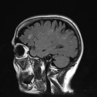 File:Base of skull chondrosarcoma (Radiopaedia 30410-31070 Sagittal FLAIR 4).jpg