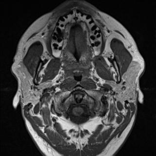 File:Base of tongue squamous cell carcinoma (Radiopaedia 31174-31884 Axial T1 29).jpg