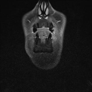 File:Base of tongue squamous cell carcinoma (Radiopaedia 31174-31884 E 23).jpg