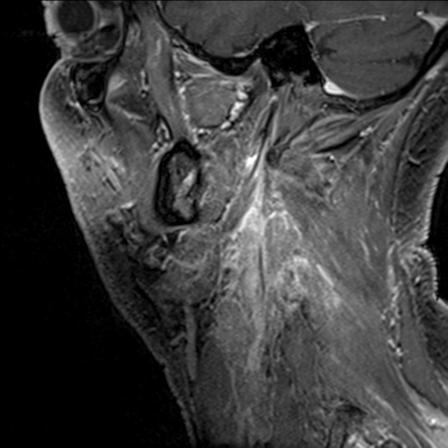 Base of tongue squamous cell carcinoma (Radiopaedia 31174-31884 F 39).jpg