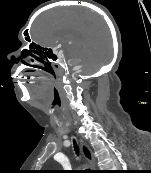 Basilar artery aneurysm (Radiopaedia 56261-62932 C 23).jpg