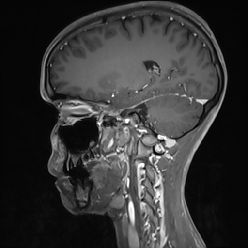 File:Basilar artery perforator aneurysm (Radiopaedia 82455-97733 G 57).jpg