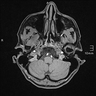 Basilar artery perforator aneurysm (Radiopaedia 82455-99523 F 9).jpg