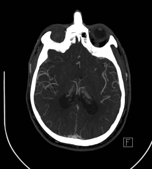 Basilar artery thrombosis (Radiopaedia 26986-27163 A 49).jpg