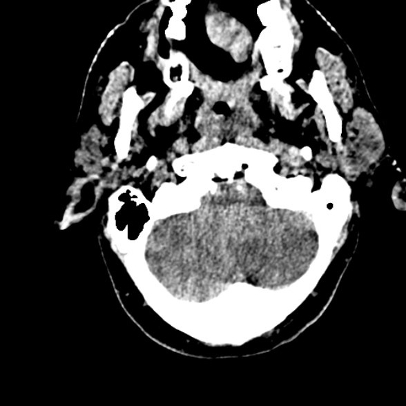 Basilar artery thrombosis (Radiopaedia 53351-59352 Axial non-contrast 22).jpg