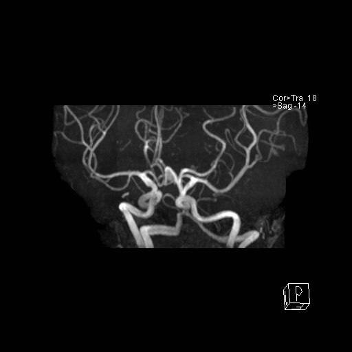 Basilar tip aneurysm (Radiopaedia 26504-26632 D 46).jpg