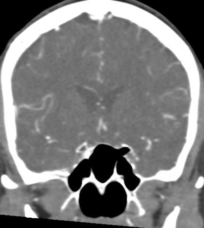 File:Basilar tip aneurysm with coiling (Radiopaedia 53912-60086 B 54).jpg