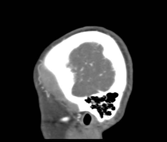 File:Basilar tip aneurysm with coiling (Radiopaedia 53912-60086 C 128).jpg