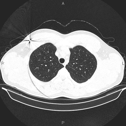 Beam hardening and ring artifacts (Radiopaedia 85323-100915 Axial lung window 21).jpg