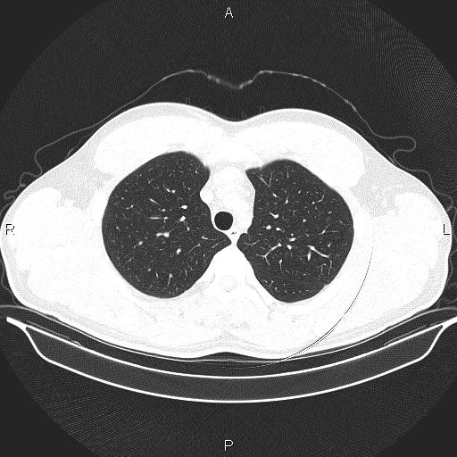 Beam hardening and ring artifacts (Radiopaedia 85323-100915 Axial lung window 22).jpg