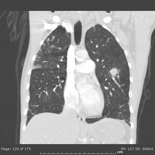 Behçet disease (Radiopaedia 44247-47889 Coronal lung window 37).jpg