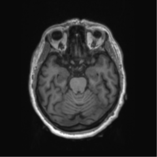 Behavioral variant frontotemporal dementia and late onset schizophrenia (Radiopaedia 52197-58083 Axial T1 71).png