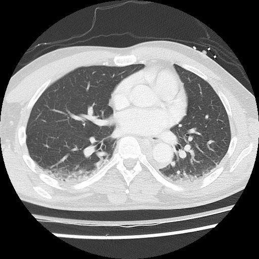 Benign post-traumatic pseudopneumoperitoneum (Radiopaedia 71199-81495 Axial lung window 41).jpg