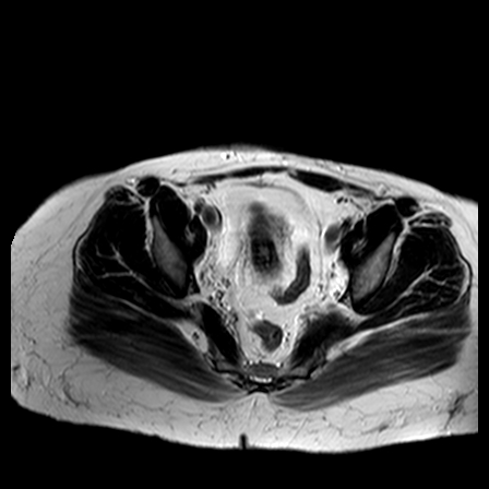 File:Benign seromucinous cystadenoma of the ovary (Radiopaedia 71065-81300 B 8).jpg