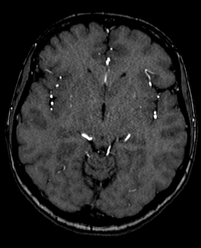 Berry aneurysm of the terminal internal carotid artery (Radiopaedia 88286-104918 Axial TOF 117).jpg