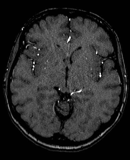 File:Berry aneurysm of the terminal internal carotid artery (Radiopaedia 88286-104918 Axial TOF 120).jpg