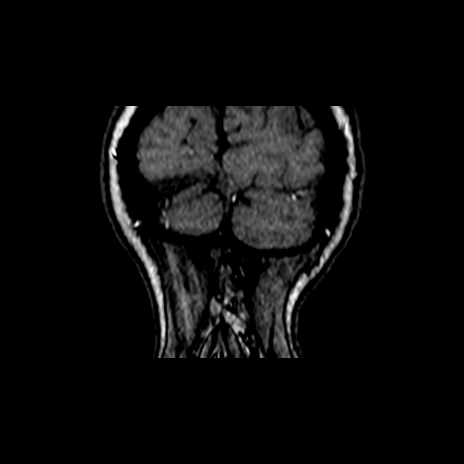 File:Berry aneurysm of the terminal internal carotid artery (Radiopaedia 88286-104918 Coronal TOF 114).jpg