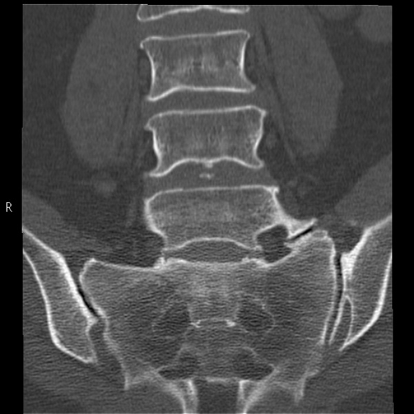 Bertolotti syndrome (Radiopaedia 24864-25128 Coronal bone window 23).jpg