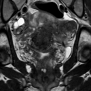 File:Bicornuate uterus (Radiopaedia 61974-70046 Coronal T2 13).jpg
