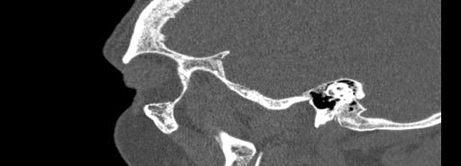 File:Bilateral Ectopic Infraorbital Nerves (Radiopaedia 49006-54084 Sagittal bone window 1).jpg