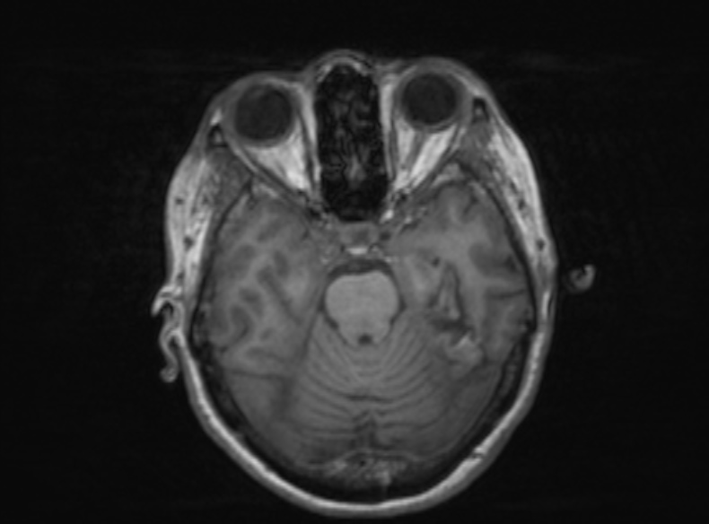 Bilateral PCA territory infarction - different ages (Radiopaedia 46200-51784 Axial T1 281).jpg