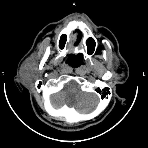 File:Bilateral Warthin tumors (Radiopaedia 84034-99263 Axial non-contrast 12).jpg