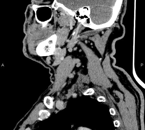 Bilateral Warthin tumors (Radiopaedia 84034-99263 D 55).jpg
