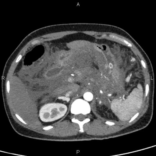 File:Bilateral adrenal gland hyperenhancement in pancreatitis (Radiopaedia 86642-102753 B 36).jpg