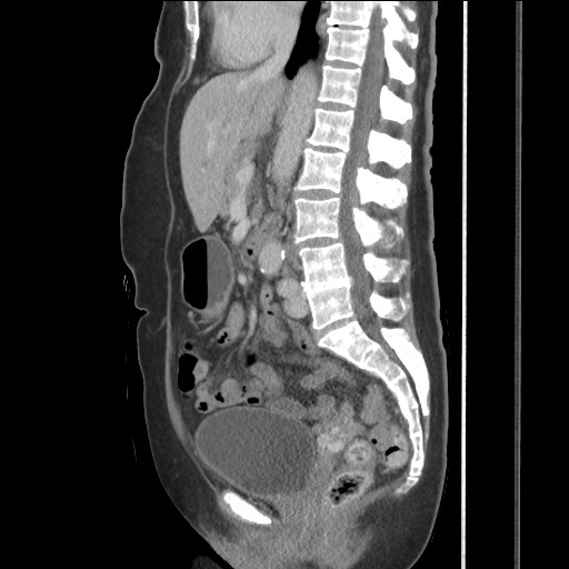 Bilateral adrenal granulocytic sarcomas (chloromas) (Radiopaedia 78375-91007 C 73).jpg