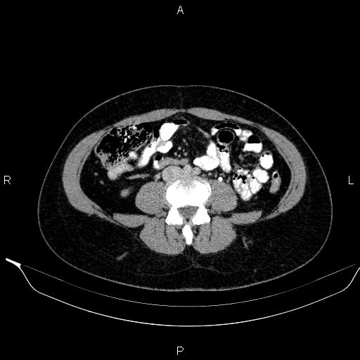 Bilateral adrenal myelolipoma (Radiopaedia 63058-71535 Axial C+ delayed 87).jpg